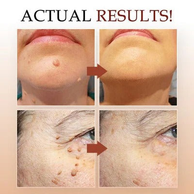 Skin Tag and Mole Appearance Cosmetic Oil